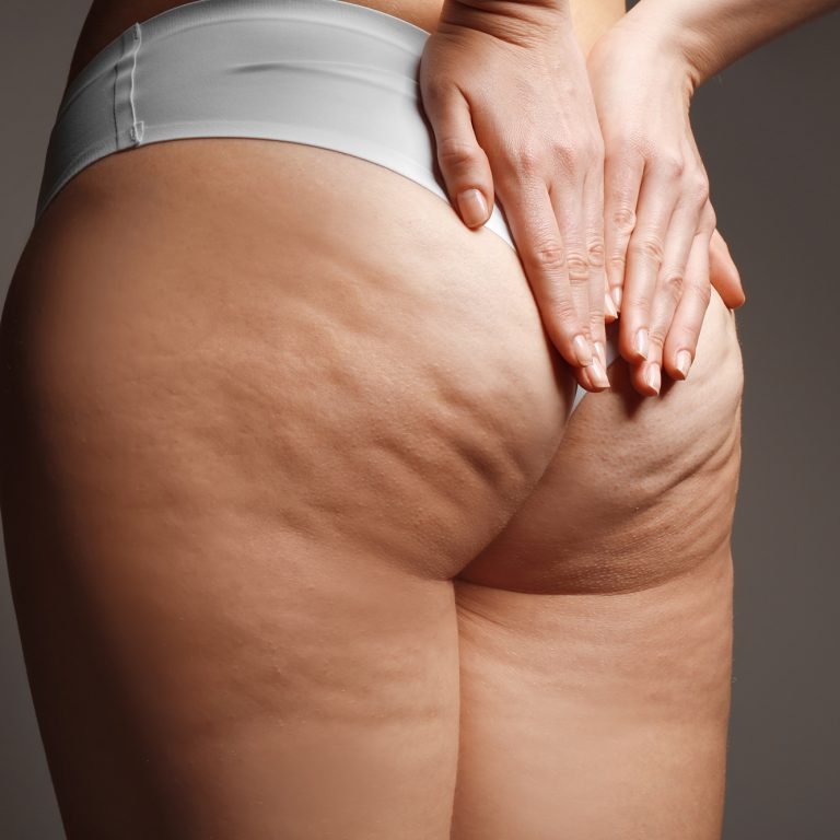 Woman with cellulite problem on dark background