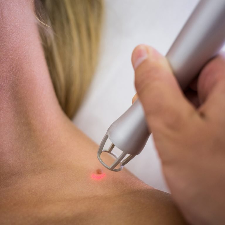 Dermatologist removing mole from womans shoulder with medical laser